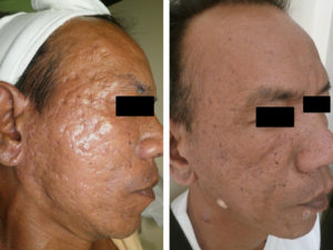 DS RF acne scars