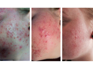rf acne 10 treatments